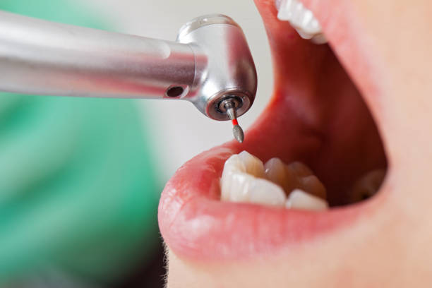 Best Emergency Dentist for Lost Fillings or Crowns in Lake Elsinore, CA